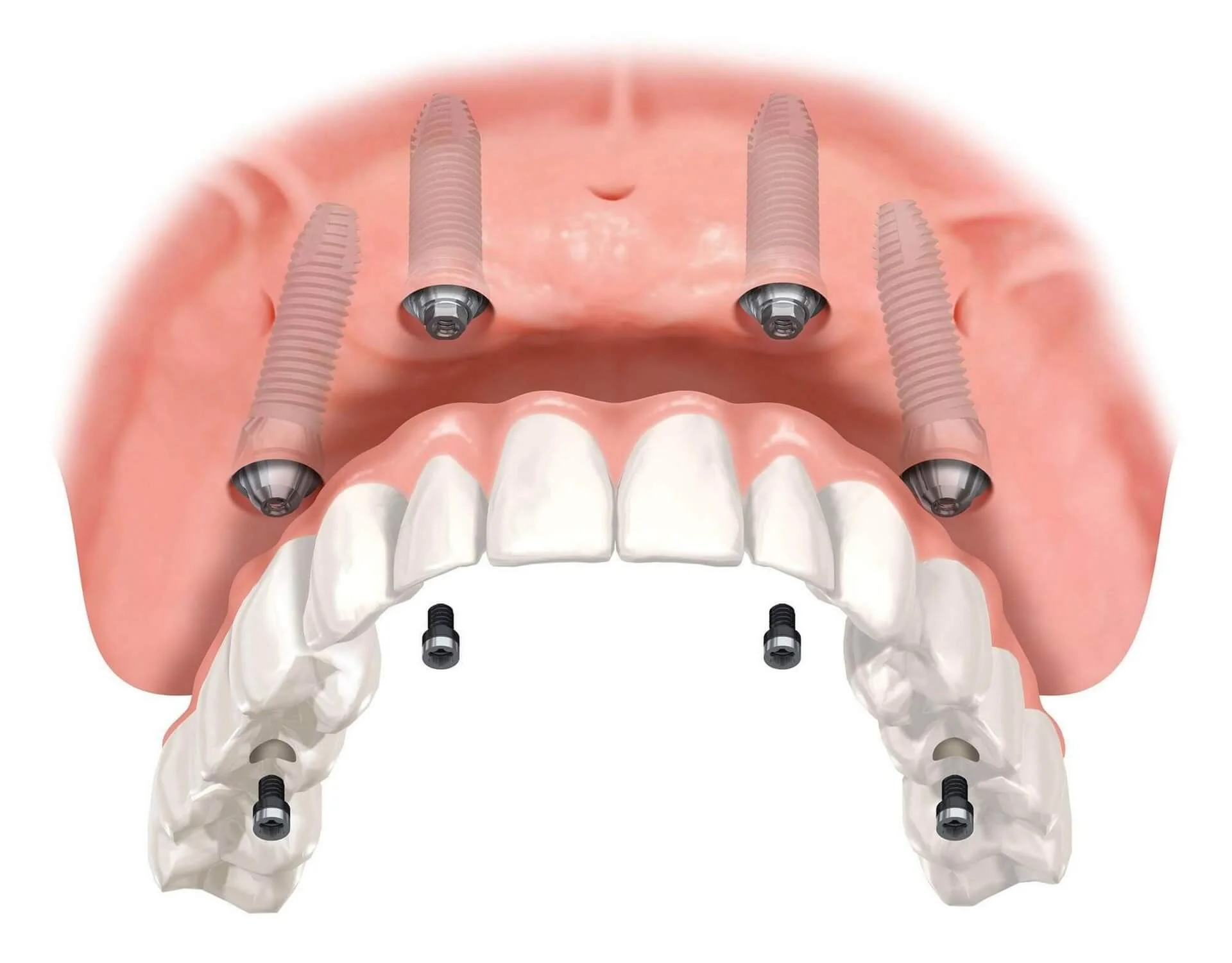 Dr_Gandhi_Dental_Clinic_Treatment_Dental_Implants_Of_Evaluation_For_Dental_Implants
