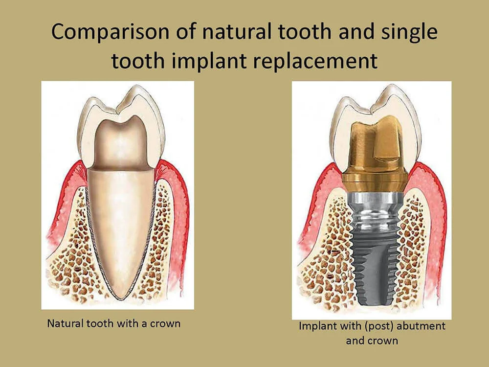 Dr_Gandhi_Dental_Clinic_Treatment_Dental_Implants_Of_Tooth_Implant_Replacement