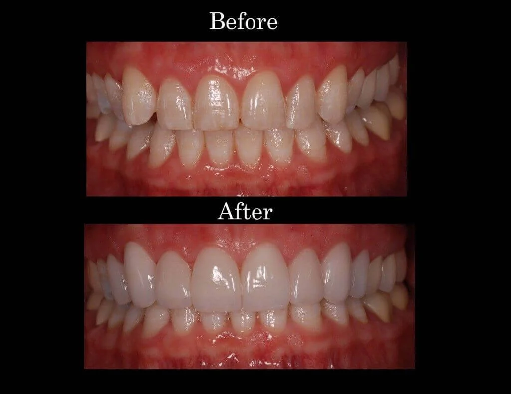 Dr_Gandhi_Dental_Clinic_Treatment_Page_image_1_of_Veneers.